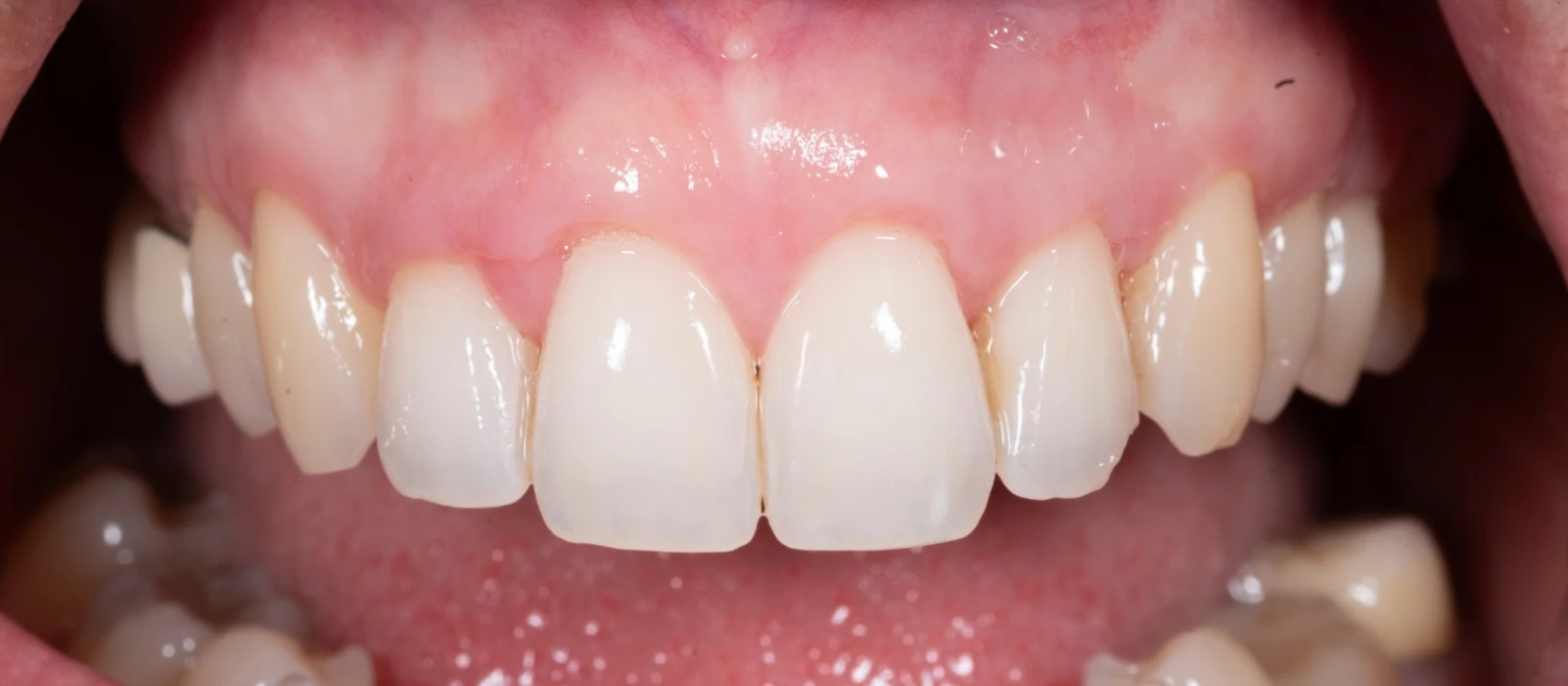 Gingival Graft III