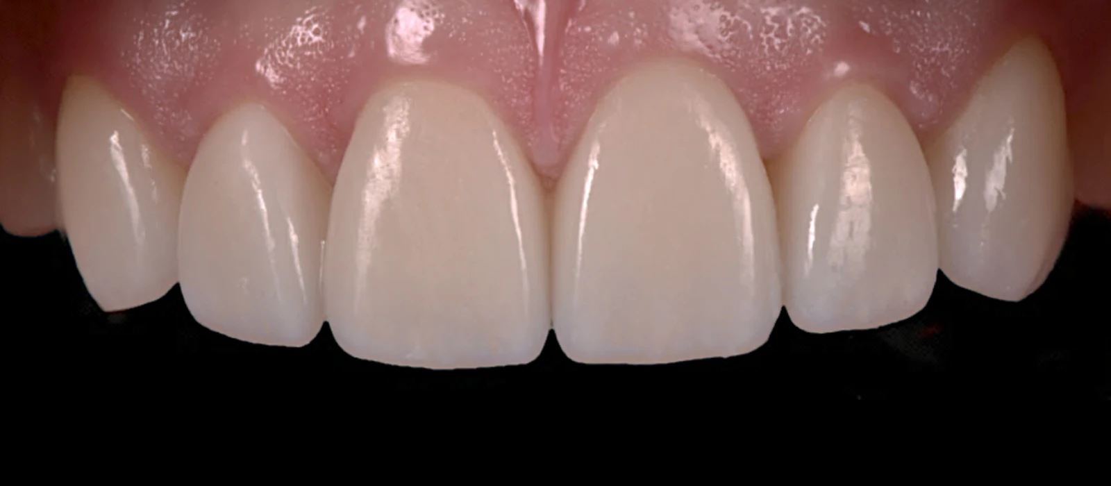 Veneers III