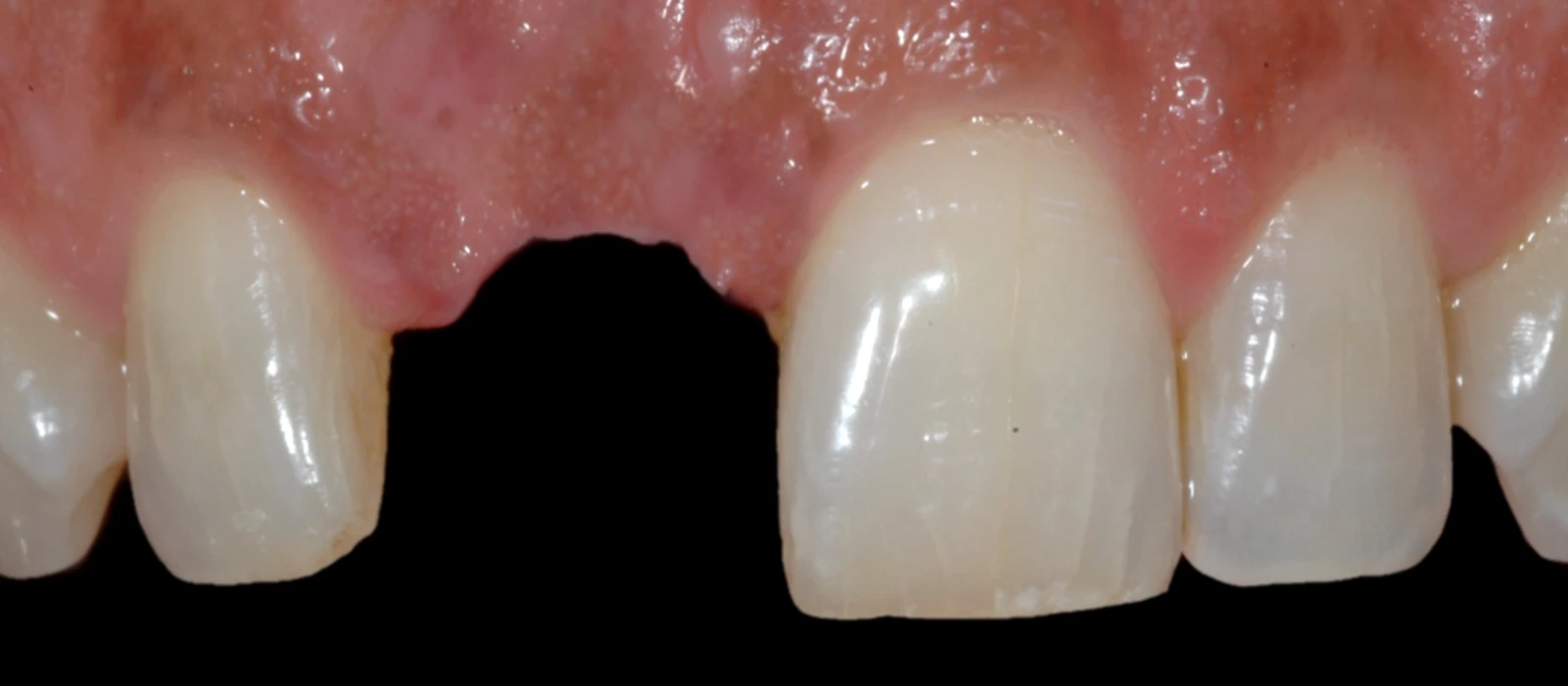 Coroas Implantes II