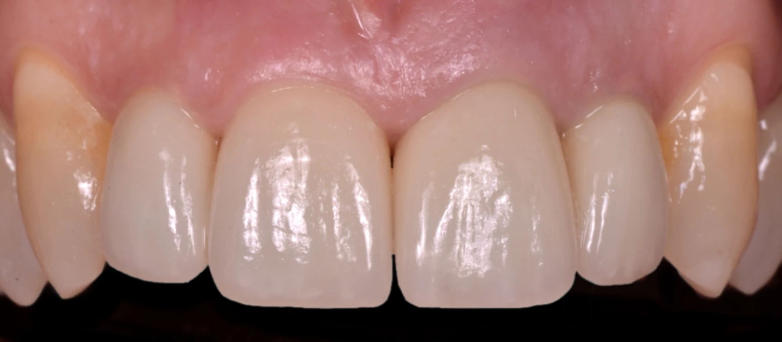 Coroas Dentes I