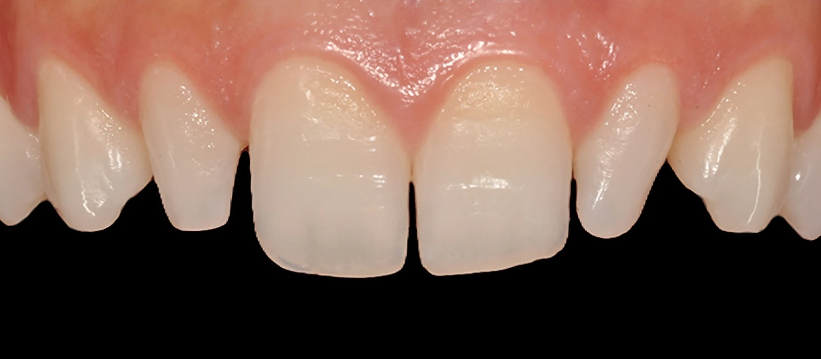 Veneers I
