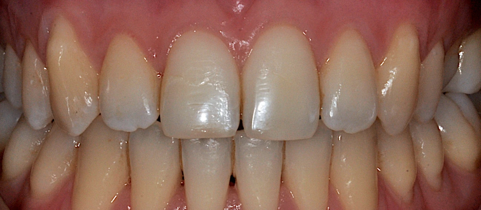Orthodontics II