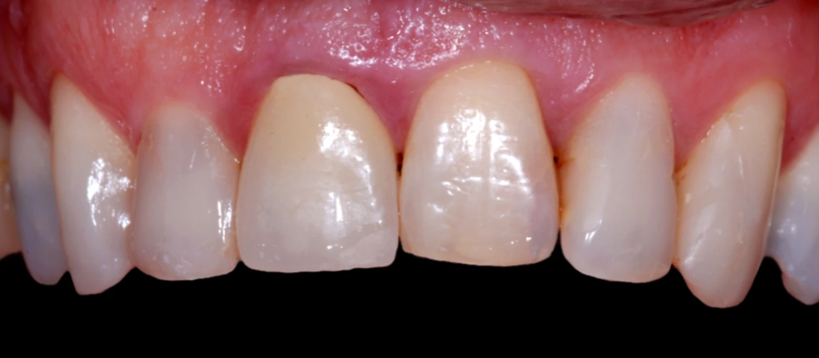 Coroas Dentes III