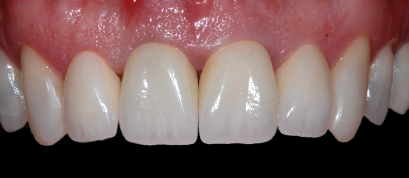 Coroas Dentes III
