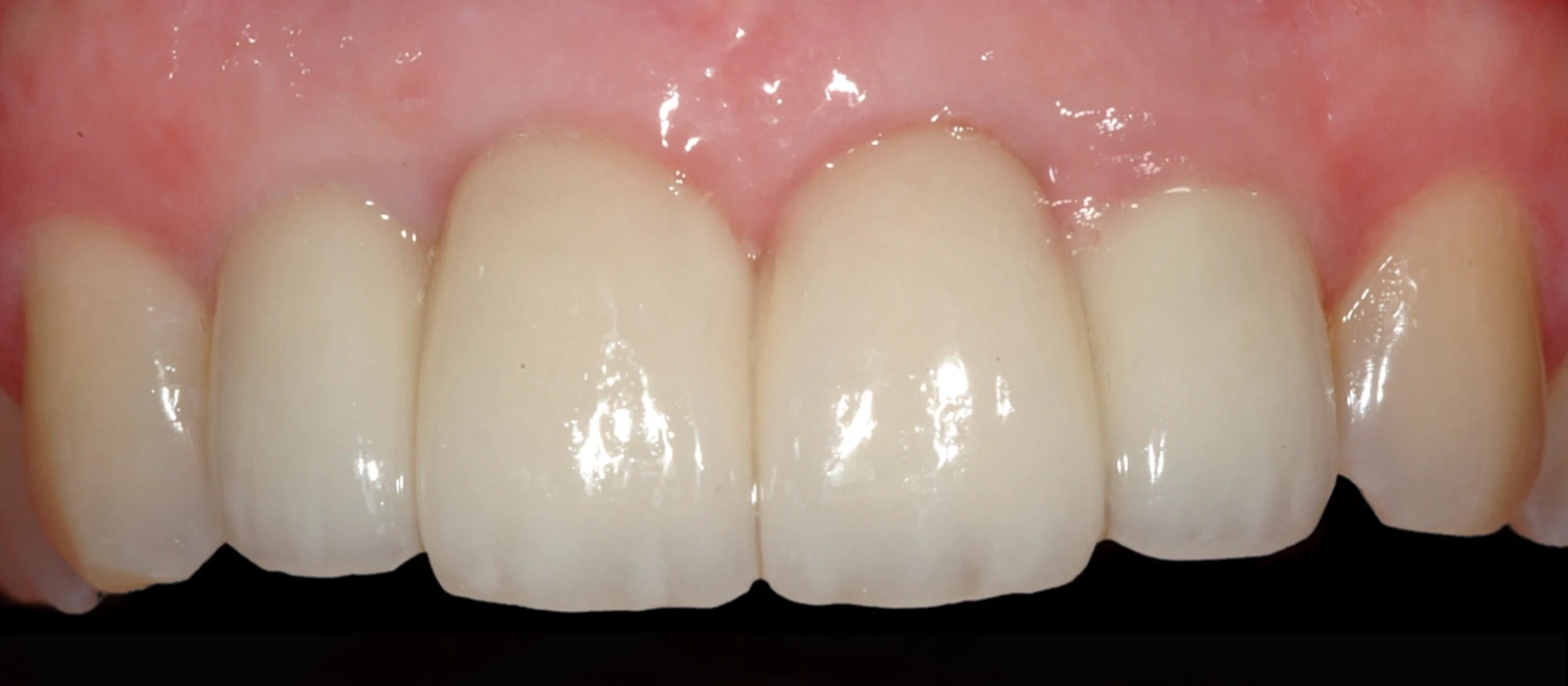 Coroas Implantes III