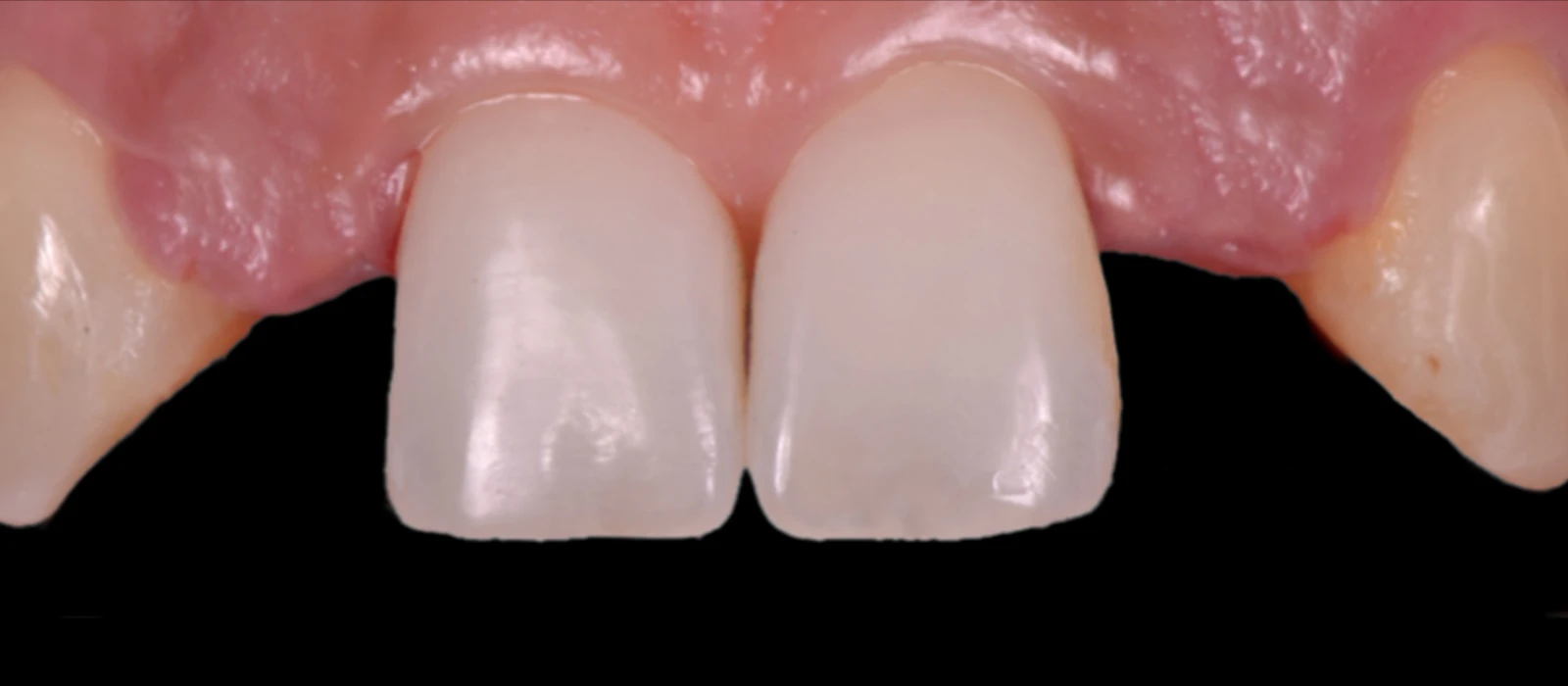 Crown Implants I