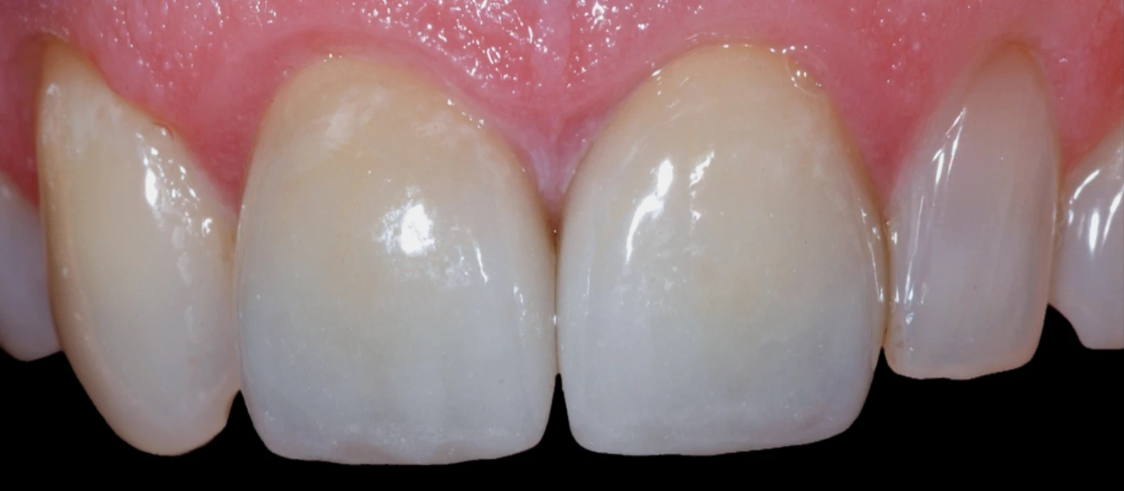 Tooth Crowns II