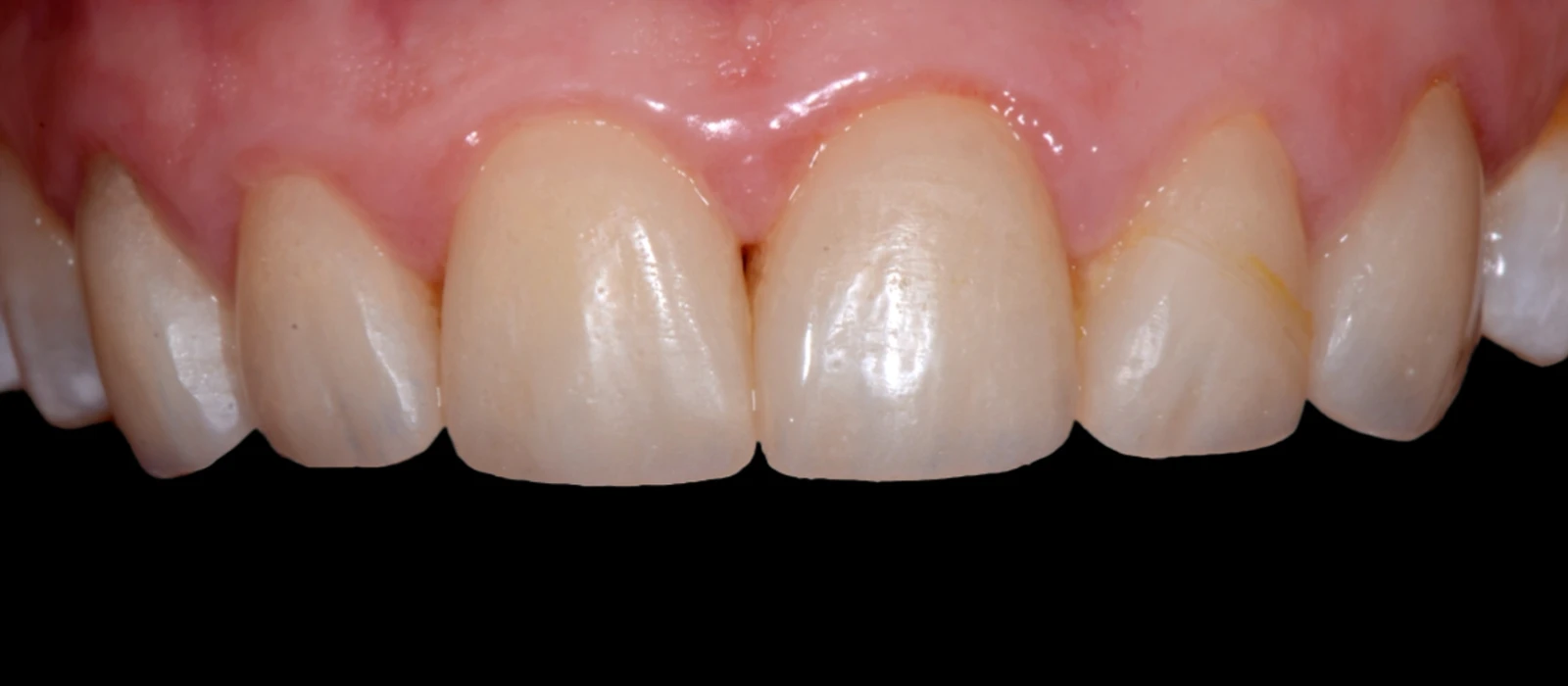 Veneers II