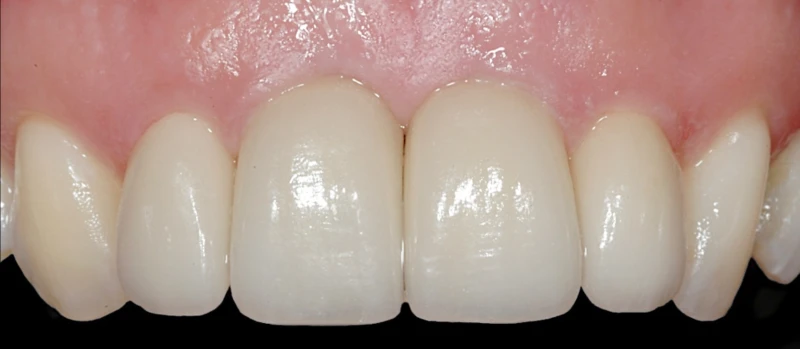 Coroas Dentes e Implantes II Antes