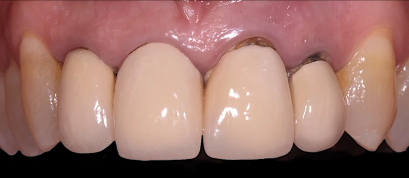 Coroas Dentes I Antes