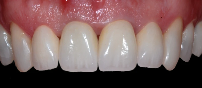 Coroas Dentes III Antes