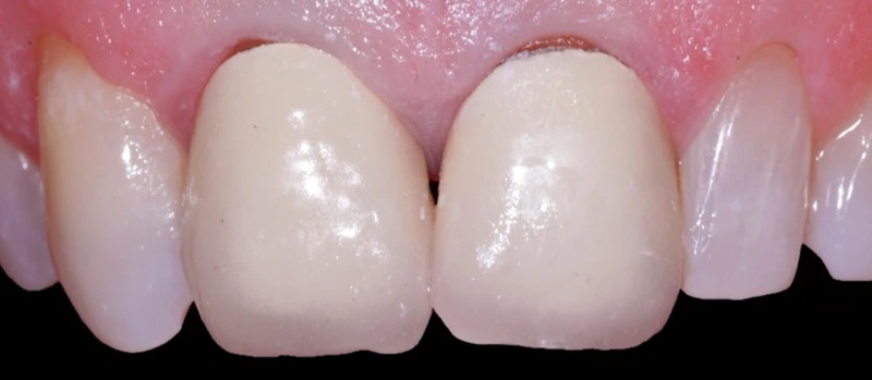 Coroas Dentes II Antes