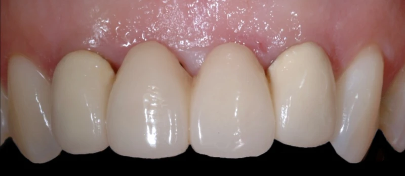 Coroas Dentes e Implantes II Antes