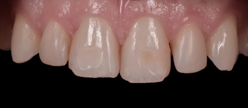 Facetas III Antes
