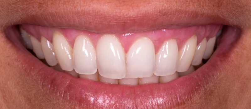 Gingival Graft I Before