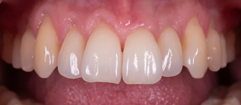 Gingival Graft II Before