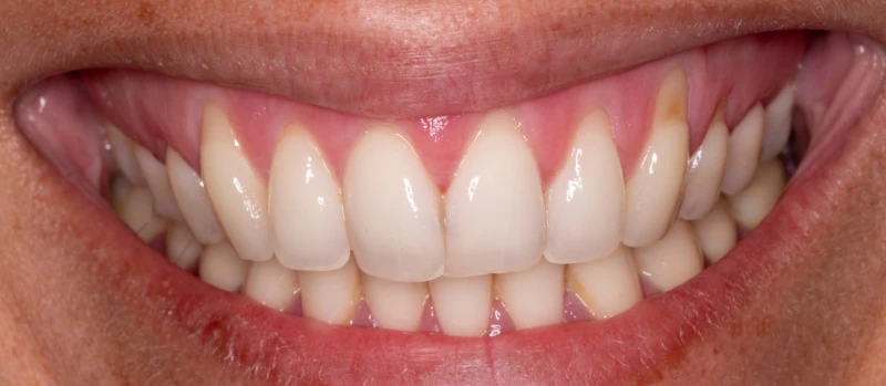 Gingival Graft I Before
