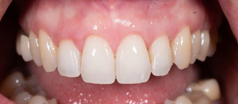 Gingival Graft III Before