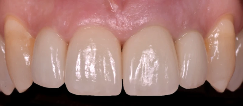 Coroas Dentes I Antes
