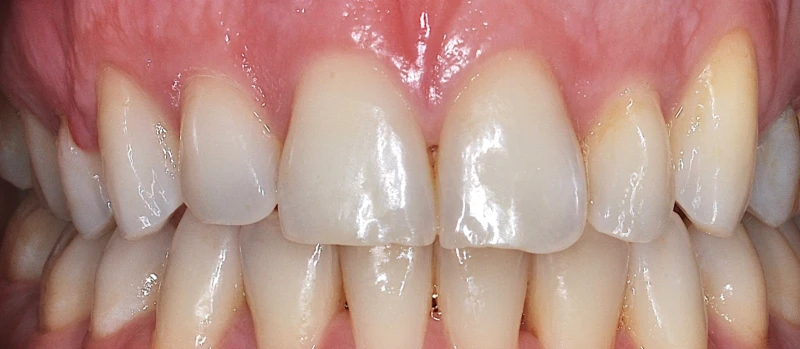 Orthodontics I Before