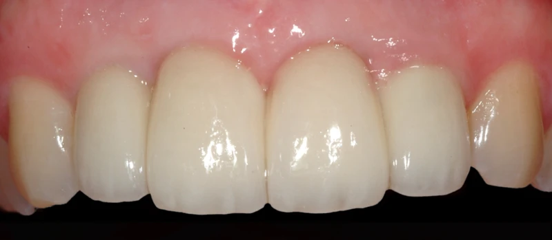 Coroas Implantes III Antes