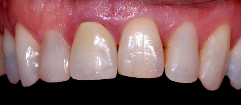 Coroas Dentes III Antes
