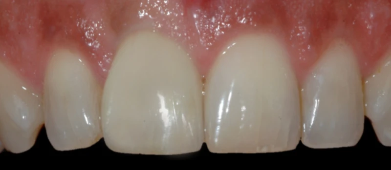 Coroas Implantes II Antes