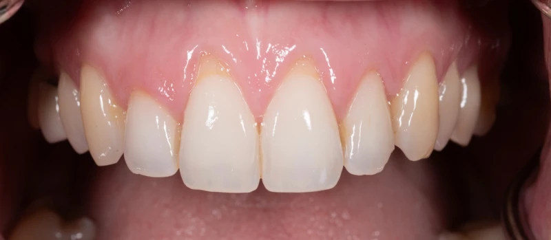 Gingival Graft III Before