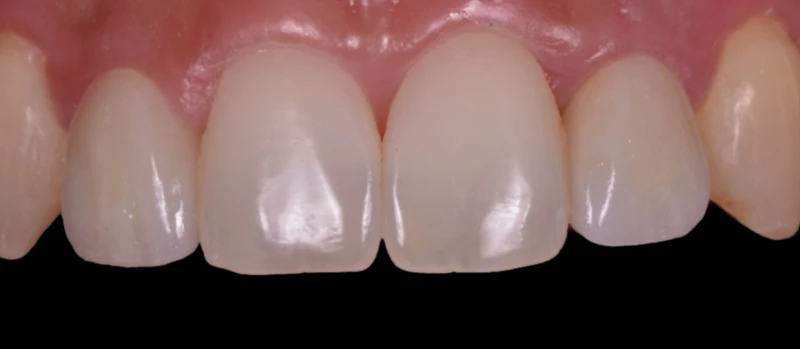 Coroas Implantes I Antes