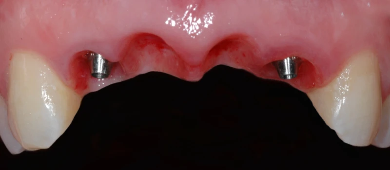 Coroas Implantes III Antes