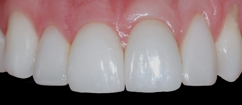 Coroas Dentes e Implantes I Antes