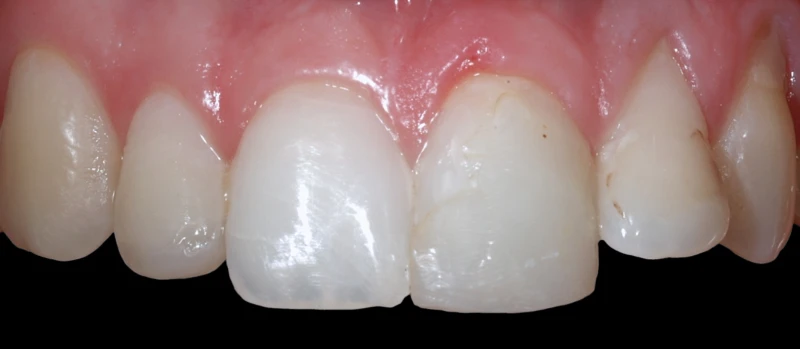 Coroas Dentes e Implantes I Antes