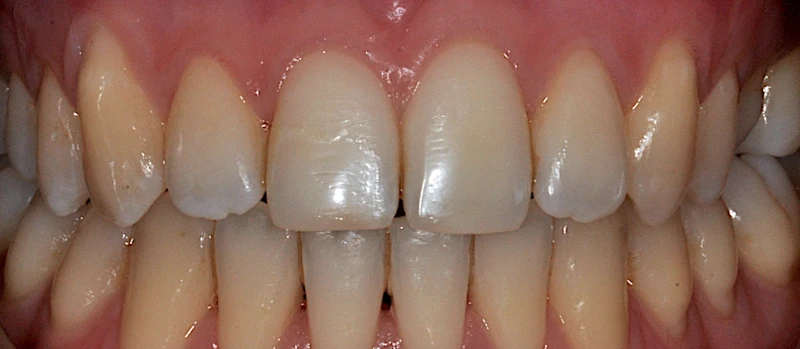 Orthodontics II Before