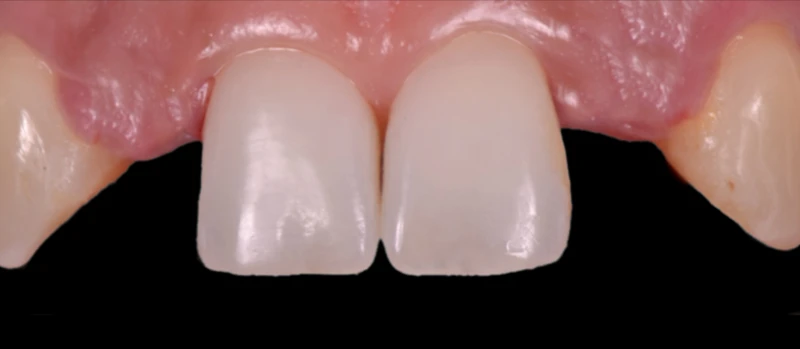 Coroas Implantes I Antes