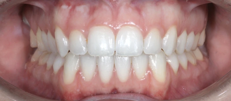 Orthodontics III Before