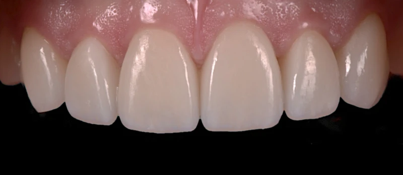 Facetas III Antes