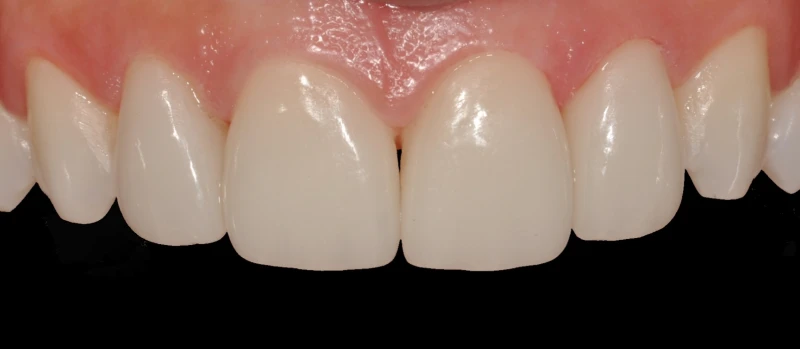Facetas I Antes