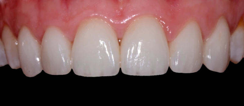 Facetas II Antes