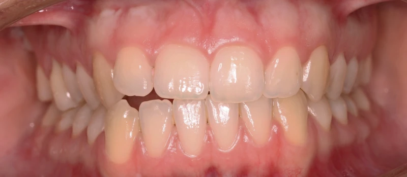 Orthodontics III Before