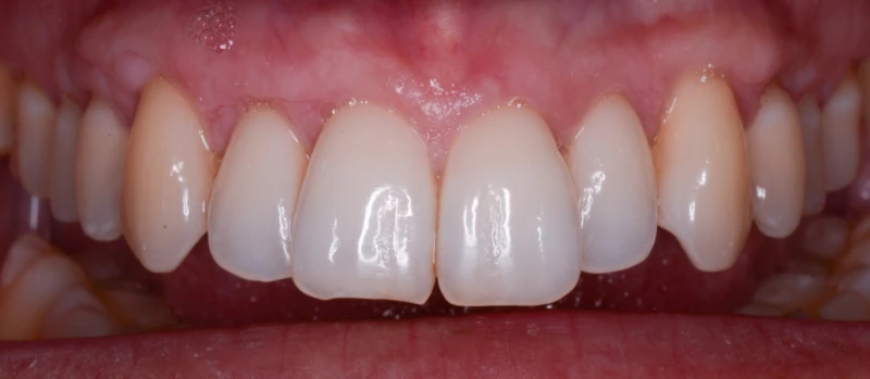 Gingival Graft II Before