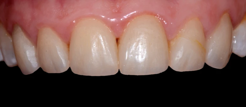 Facetas II Antes