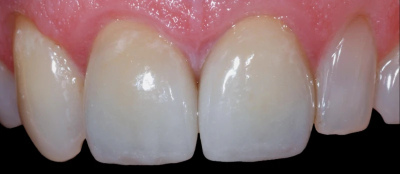 Coroas Dentes II Antes